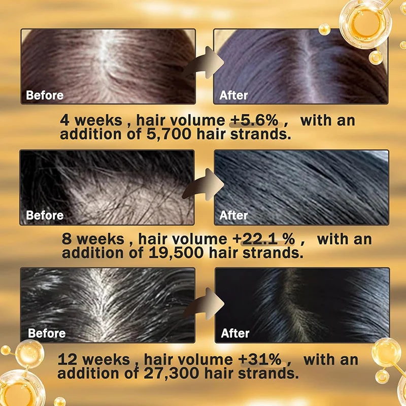 Hair Growth Serum Advanced Minoxidil & Herbal Formula Nourishes Follicles Strengthens Roots Reduces Hair Loss 60ml 4 hair growth serum minoxidil herbal follicle nourishment 60ml sit 7hsx5xe8 desc 4
