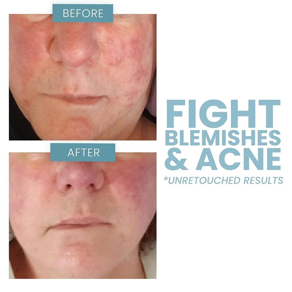 Retinol Serum with Hyaluronic Acid and Vitamin E 30ml Anti-Aging Face Treatment 6 retinol serum hyaluronic acid vitamin e anti aging face treatment sit 4ptrnuqs desc 6